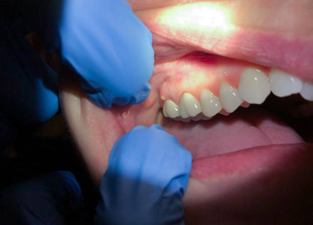 Best Emergency Treatment for Dental Infections or Abscesses in Colonial Heights, VA